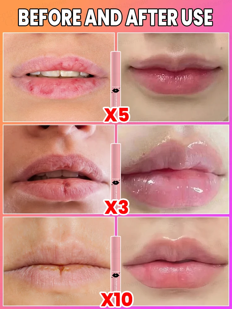 Lip Augmentation in one month