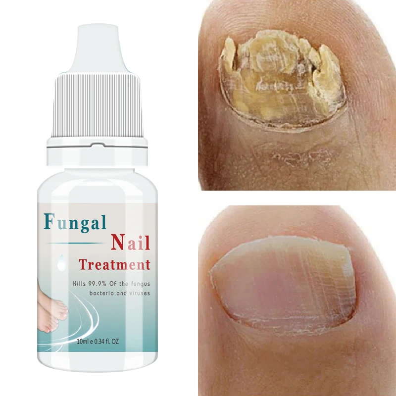 

Nail Fungus Treatment Serum Foot Repair Essence Toe Nails Fungal Removal Gel Anti Infection Paronychia Onychomycosis Cream 10ml