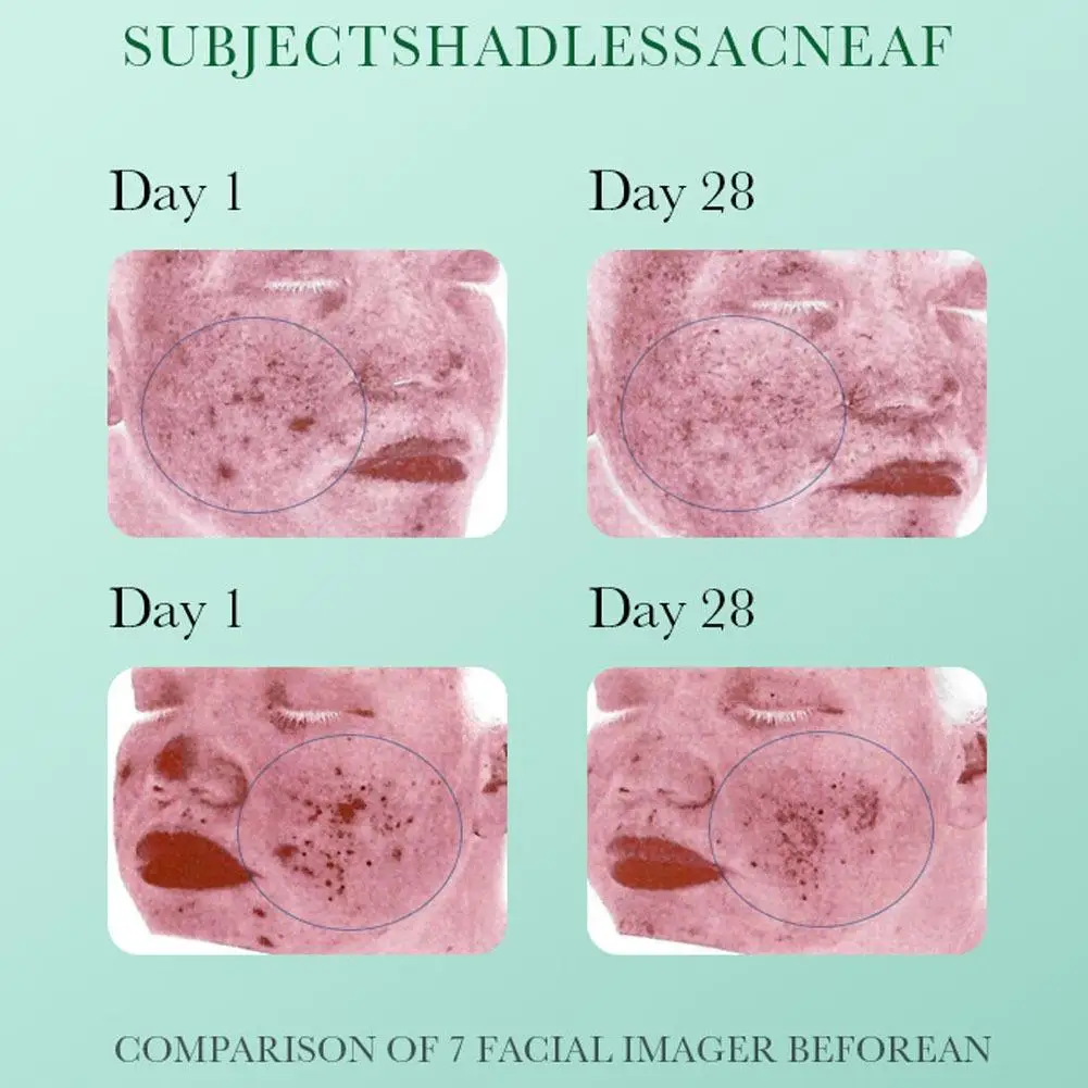 35 مللي حمض الساليسيليك حب الشباب إزالة مصل الوجه...