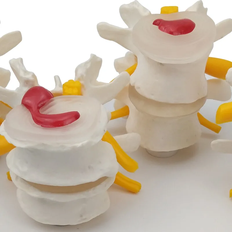 Anatomical Models 4-stage Pathological Human Lumbar Spine Anatomy Model Medical Science Teaching Resources