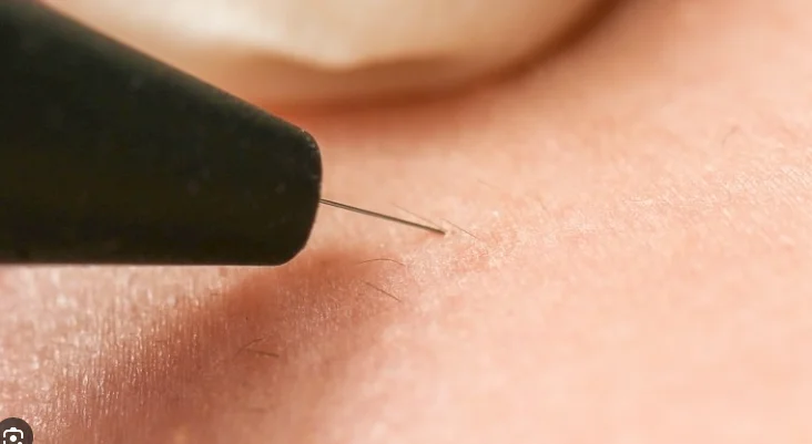 Máquina de electrólisis no invasiva para el hogar, avanzada