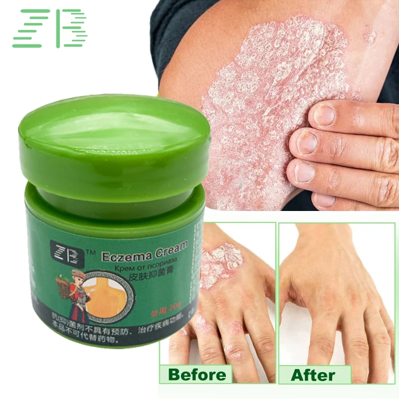 Skin Care Ointment 20g Psoriasis Cream Dermatitis Eczematoid Treatment Antibacterial Anti-Itch