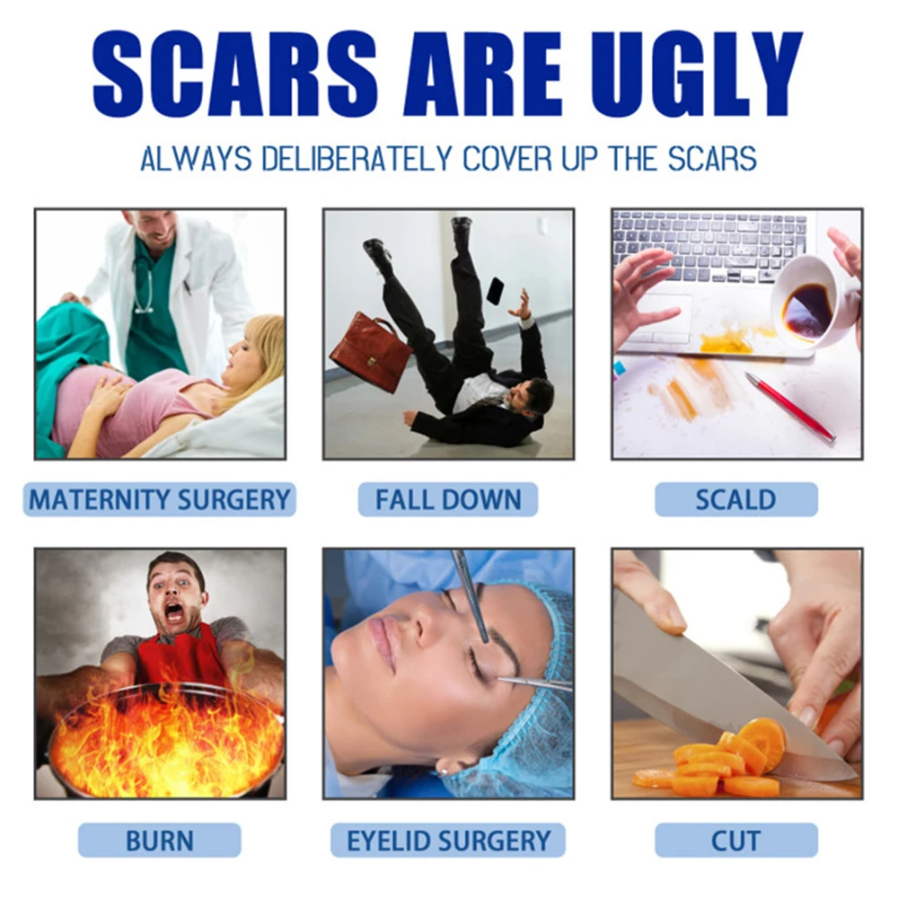Scar Removal Cream for Keloid Burn Surgical Scars