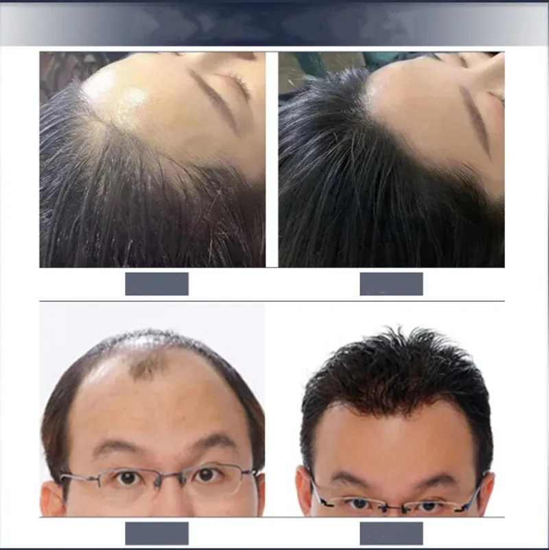 ZS Stem Cell Hair Growth Serum EGF Lyophilized Powder 28 Days Fast Grow Hair Regrowth Kit Growth Factor Loss Treatment for hair growth serum