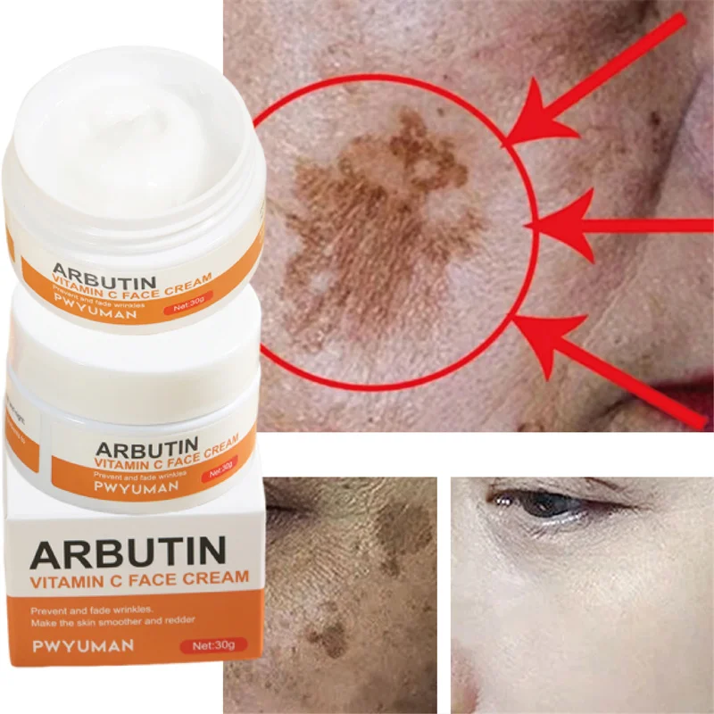 

Freckle Removal Whitening Face Cream Remove Dark Spots Chloasma Lighten Pigmentation Moisturizing Rejuvenating Skin Care Product