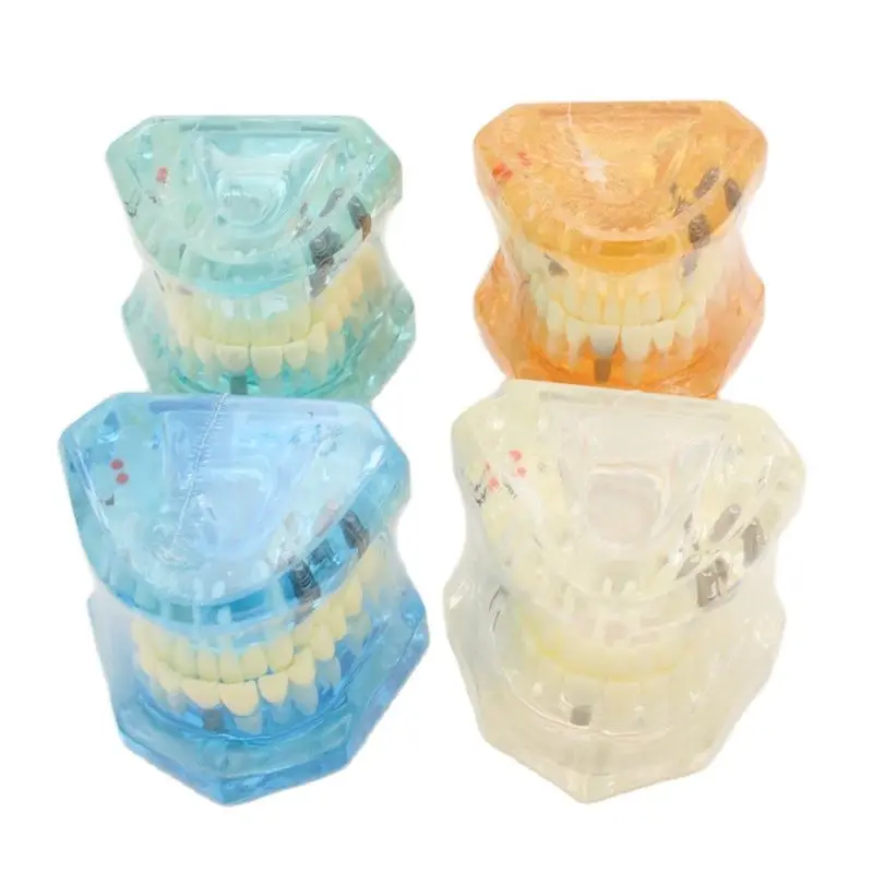 

1Pcs Dental Model Teeth Implant Restoration Bridge Teaching Study Medical Science Disease Dentist Dentistry Products Dental Gift