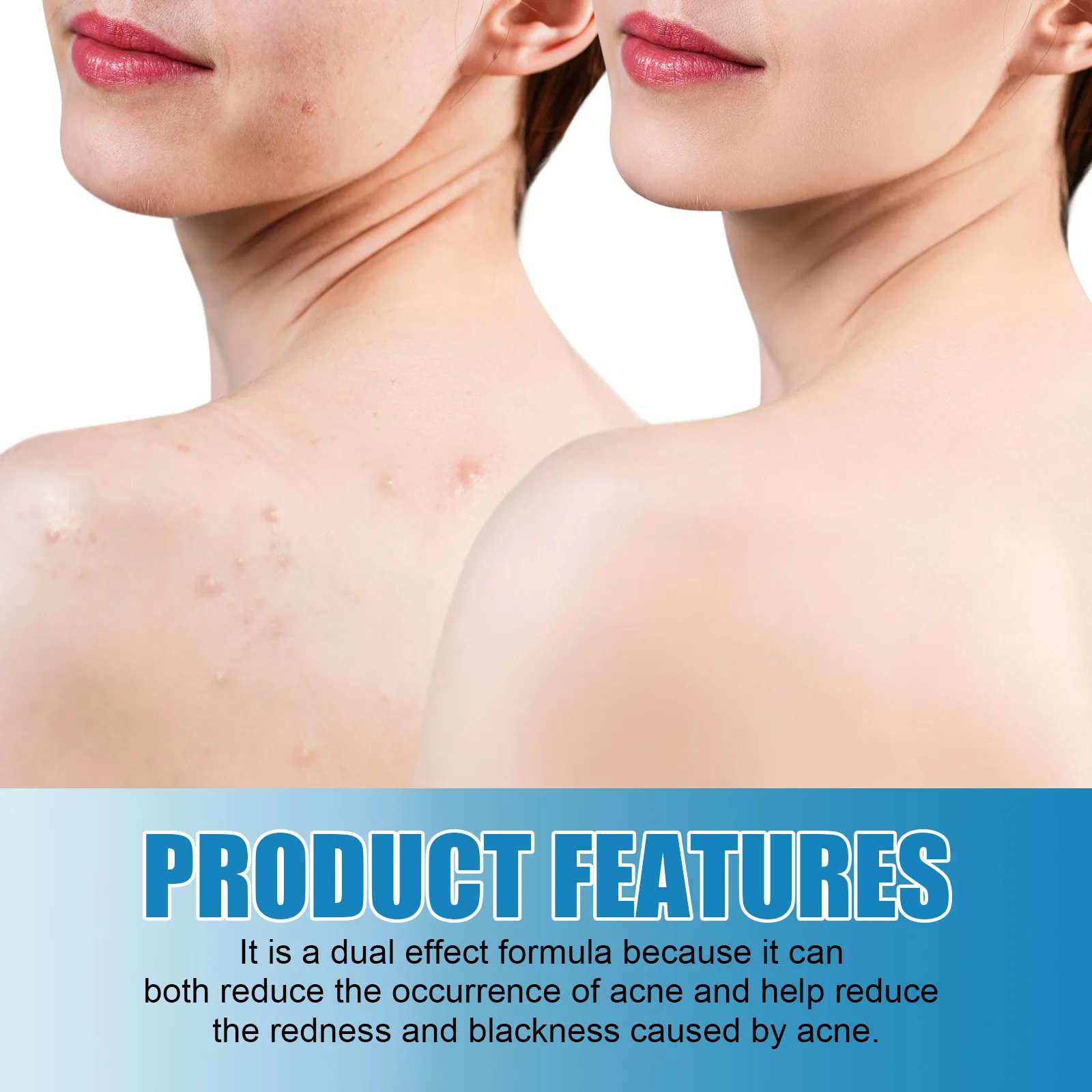 Picture of Acne Rosacea Chest