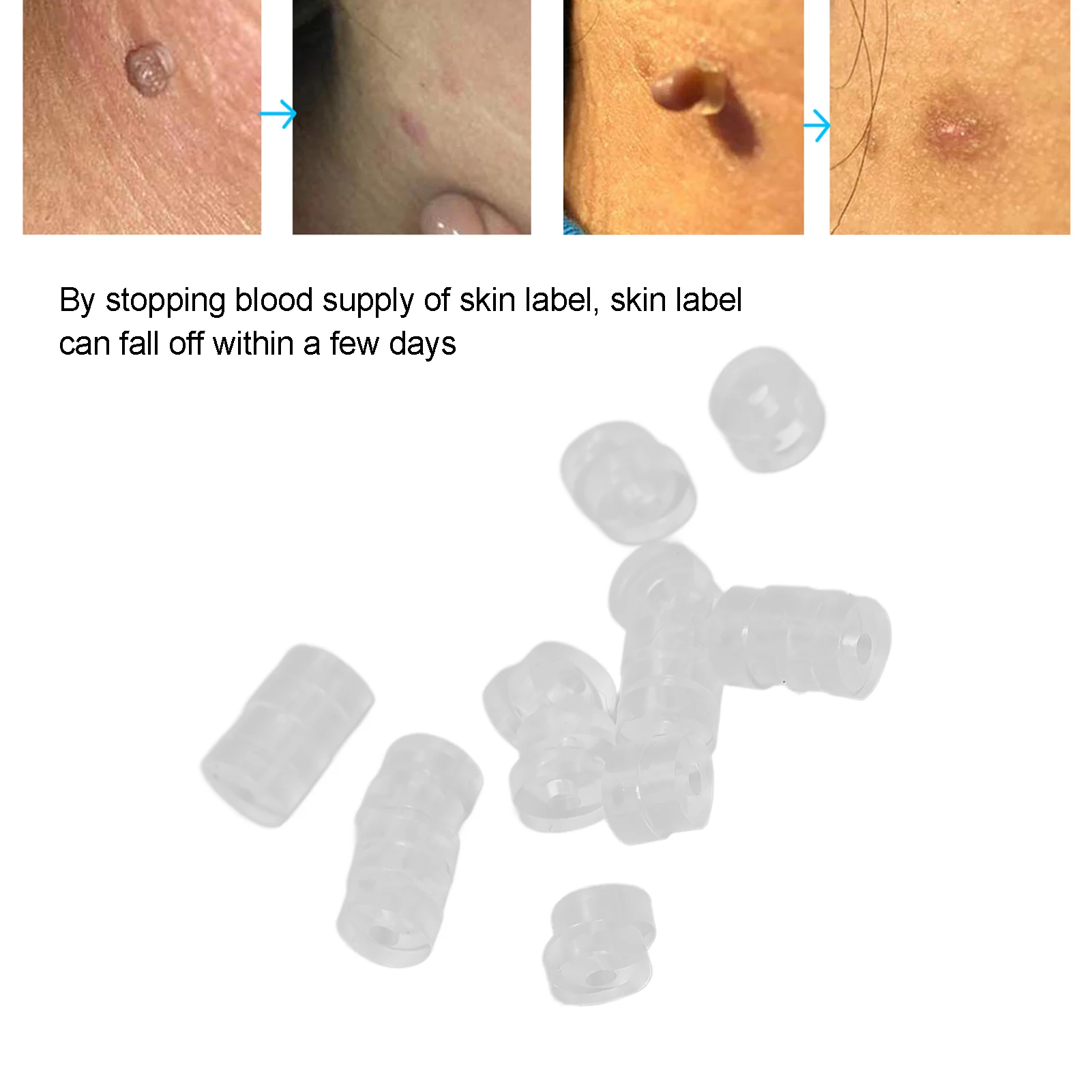 30pcs Face Care Skin Tag Rubber Bands Beauty Health Mole Wart Removal Rubber Bands Skin Tag Removal Kit Micro Skin Tag Band