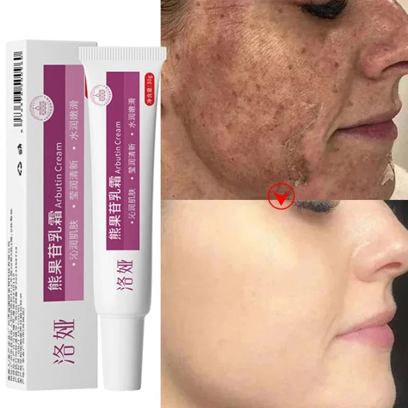 Face Dark Spots Remover Effective Whitening Remove Melasma Freckles Cream Removal Melanin Skin Brightening Face Care Products