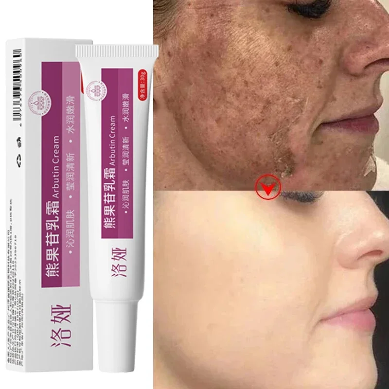 

Face Dark Spots Remover Effective Whitening Remove Melasma Freckles Cream Removal Melanin Skin Brightening Face Care Products