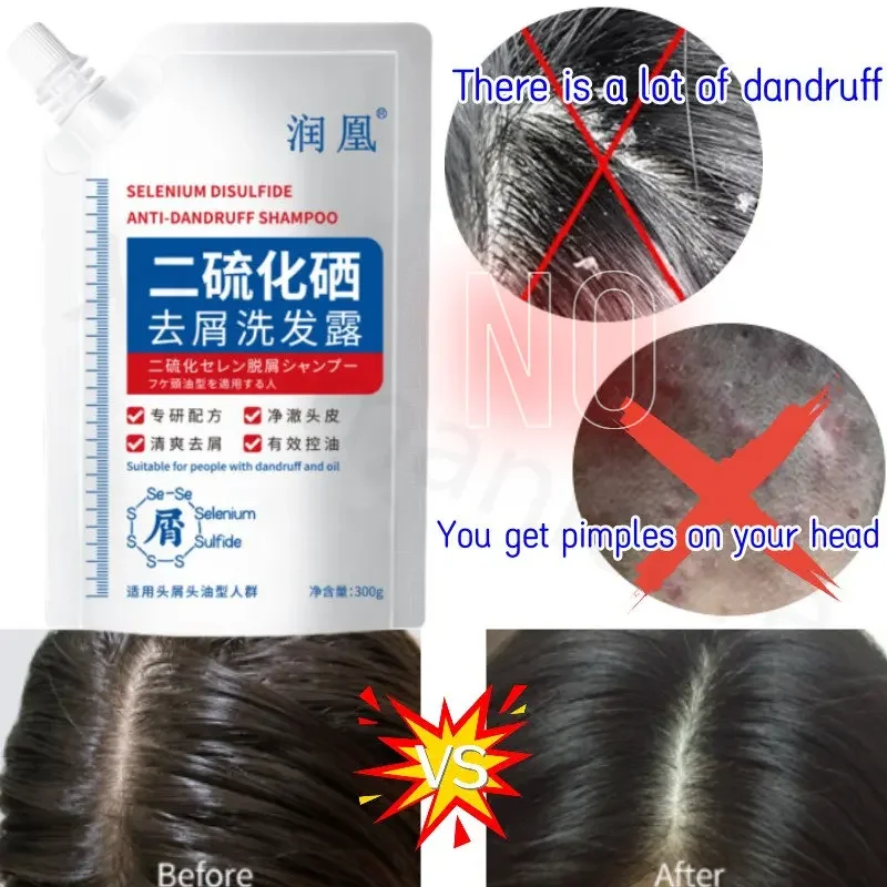 300ml Selenium Disulfide Anti-dandruff Antipruritic Control Head Issue Oil Deep Cleansing Scalp Nourishing Hair Bagged Shampoo stethoscope engine stethoscope set repair tester stethoscope stainless steel engine issue detection listening tool hearing tool