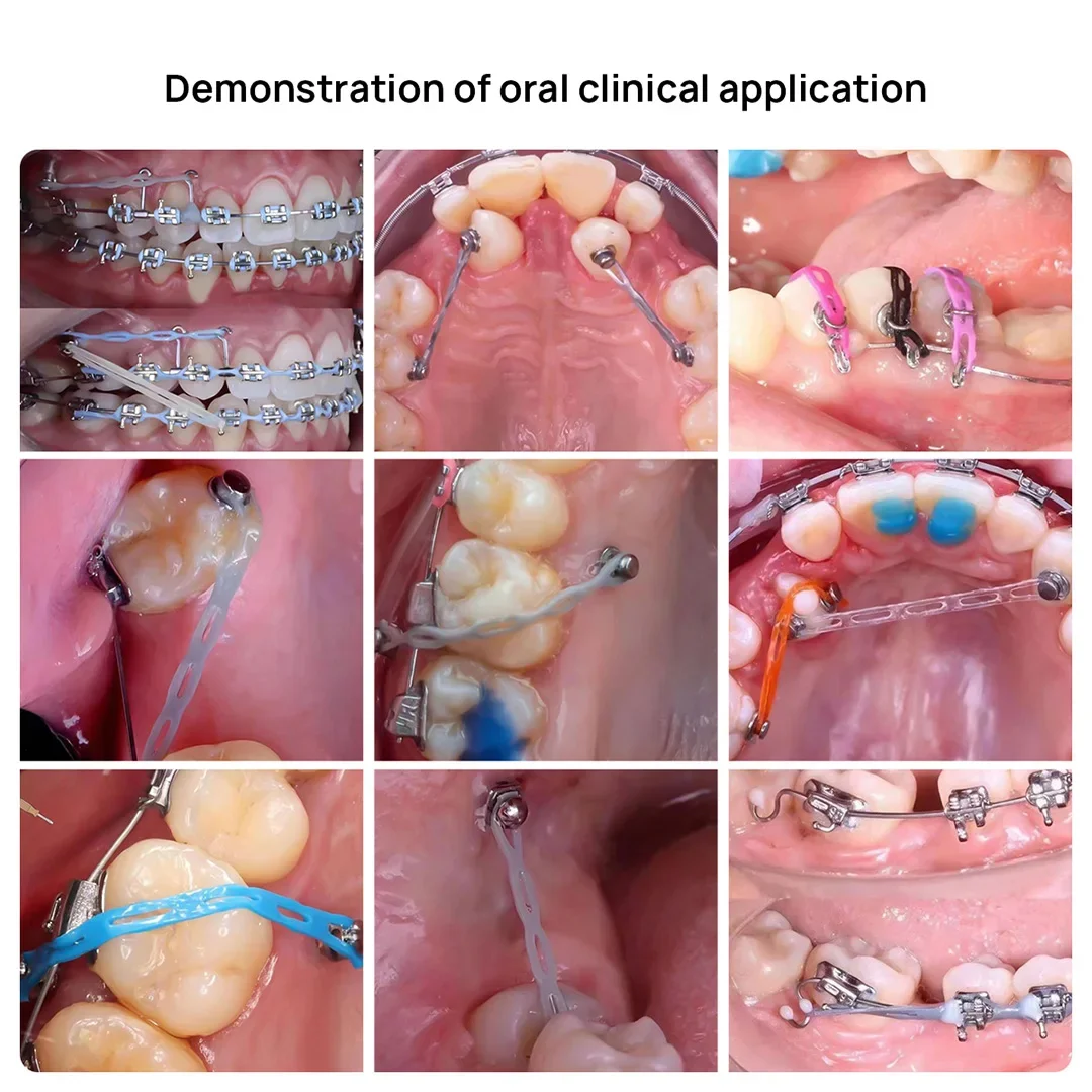Chaîne élastique Orthodontique – 15 Pieds (rouleau), Bande Souple Pour Braces, Sans Marque
