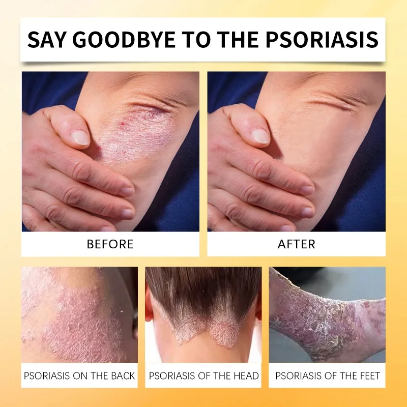 Skin Psoriasis Spray Natural Herb Eczema Treatment Spray Itch Relief Improve Redness Dermatitis Psoriasis Health Care 20ml