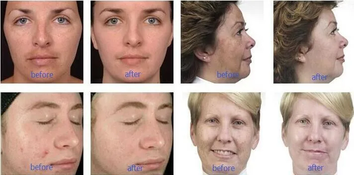 Upgrade your aesthetic services with the AQUA SKIN SMART 9-in-1 facial machine. Featuring hydro dermabrasion, RF, ultrasound, oxygen infusion, and microcurrent technology for deep cleansing, lifting, and skin rejuvenation. Ideal for clinics and beauty salons. AQUA SKIN SMART 9-in-1 Multifunction Facial Machine