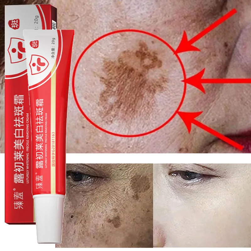 

Freckle Whitening Cream Remove Black Dots Melasma Anti Brown Stain Lightening Pigmentation Moisturizing Rejuvenation Skin Care