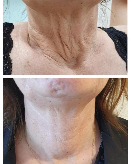 Plasma Pen – Eyelid Lift, Wrinkle & Dark Spot Removal
