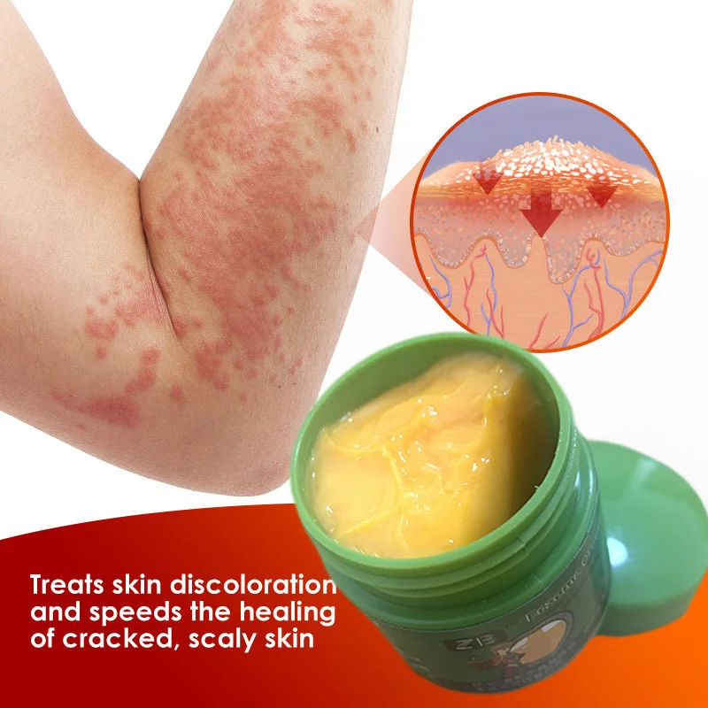 Skin Care Ointment 20g Psoriasis Cream Dermatitis Eczematoid Treatment Antibacterial Anti-Itch