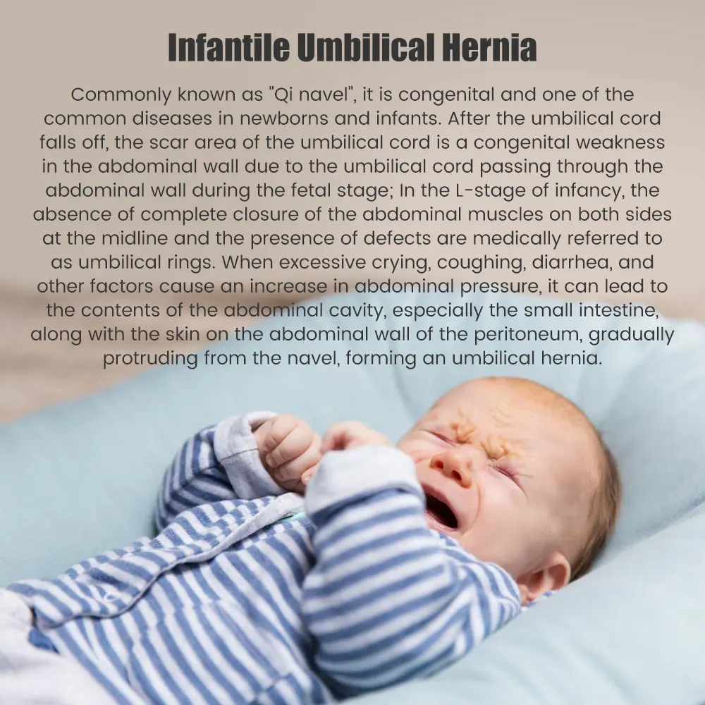 Infant Inguinal Umbilical Hernia Belt Navel Support Stickers Treatment Newborn Baby Belly Button with 3 Hernia Pad