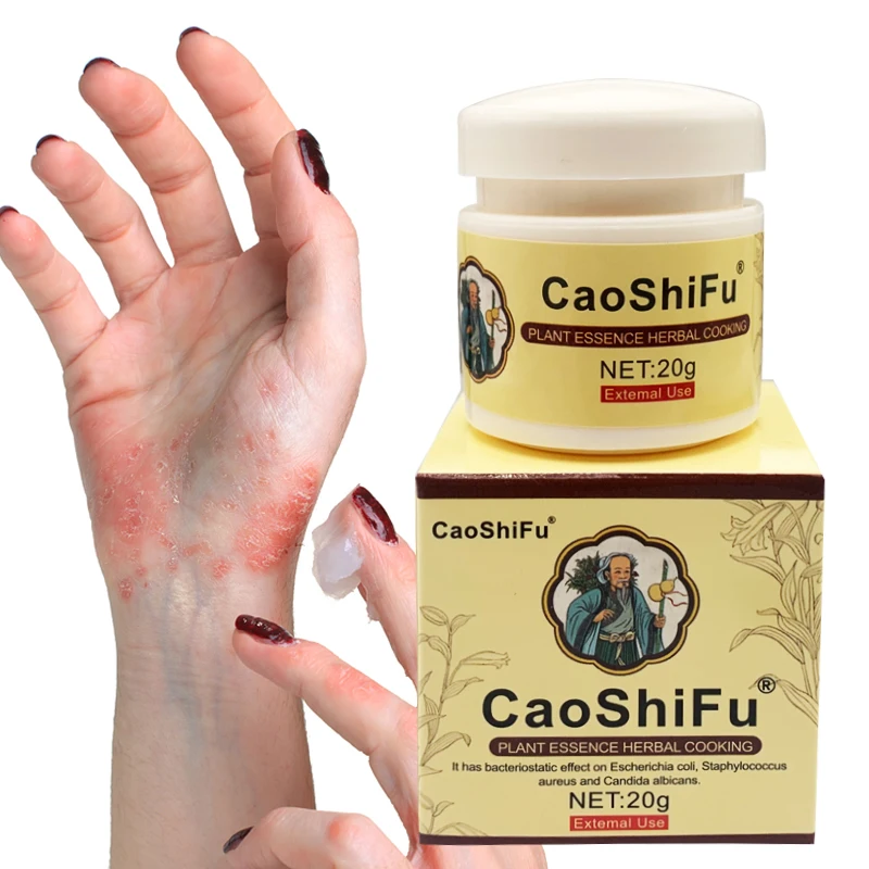 

20g ZB Skin Psoriasis Ointment Dermatitis Eczematoid Eczema Cream Effective Relief Anti-itch Chinese Herbal Medicine