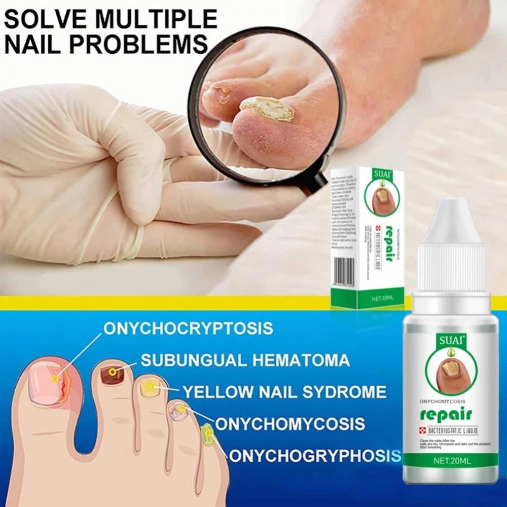 Suai Nail Repair Liquid Antifungal Remove Onychomycosis Quickly