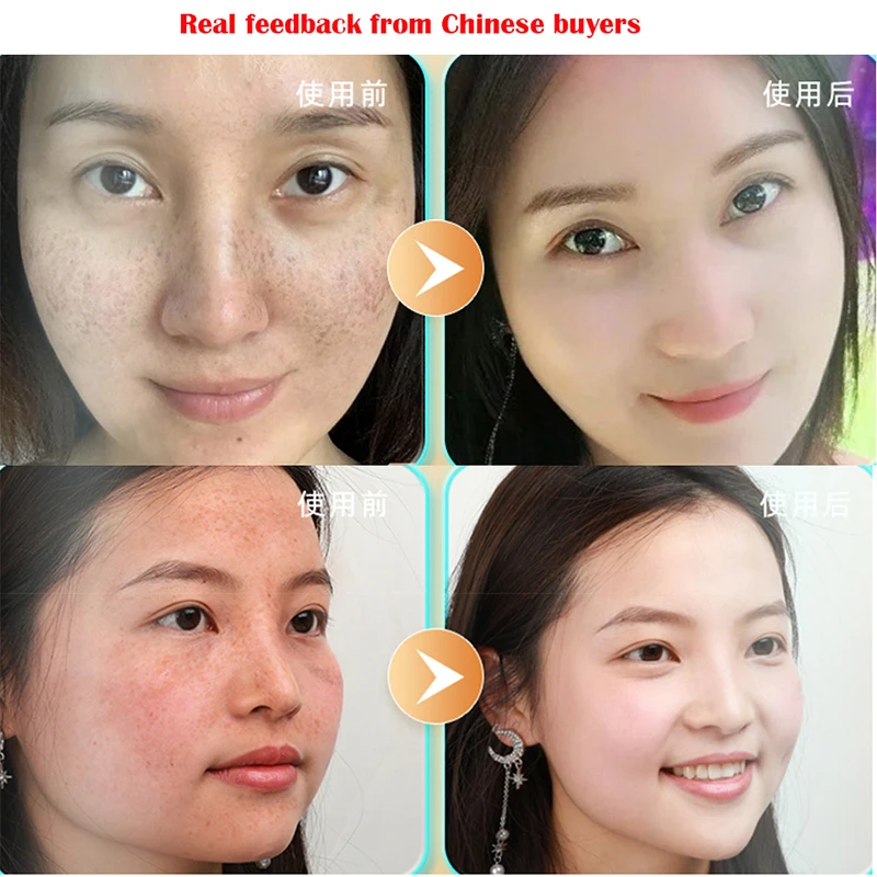 Whitening Freckles Cream Remove Melasma Dark Spot Lightening Melanin Removal Melasma Remover Moisturize Brighten Face Skin Care