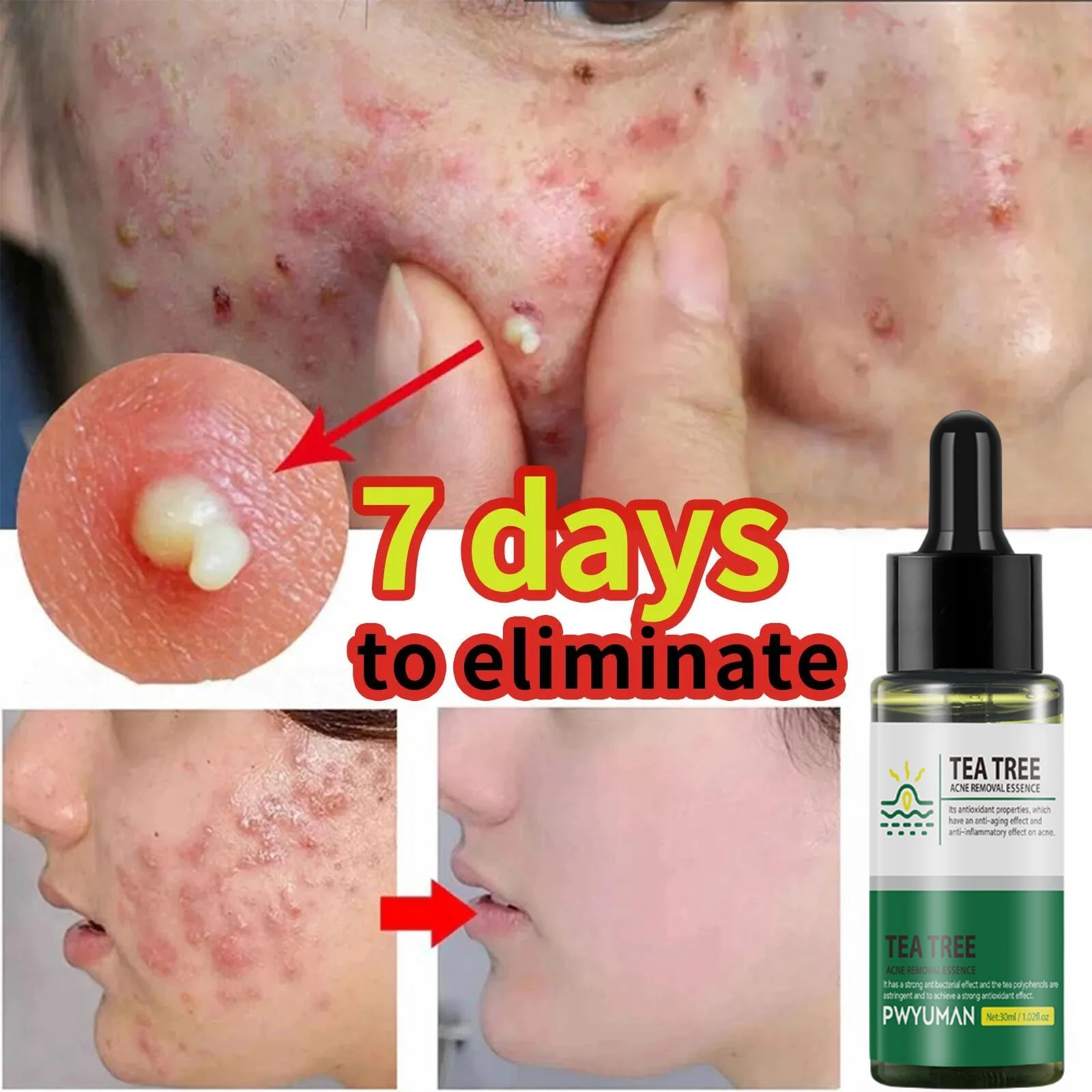 Original Tea Tree Acne Remove Serum Lighten Black Spots Acne Mark Replenish Water Repair Damage Pore Brighten Korean Skin Care rs 1 5t water softener 1 5t per hour cationic resin remove the calcium and magnesium clamping connect prevent leakage