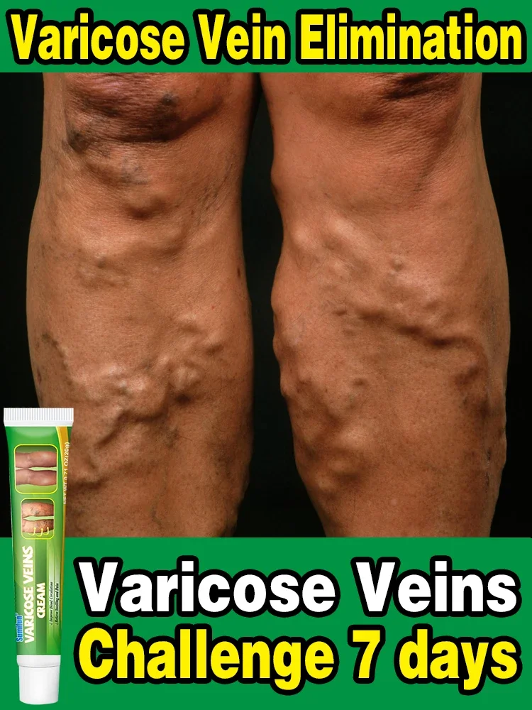 Effective Varicose Vein Relief Cream Ointment for Varicose Veins to Relieve Vasculitis Phlebitis Spider Pain Relief varicose vein ointment