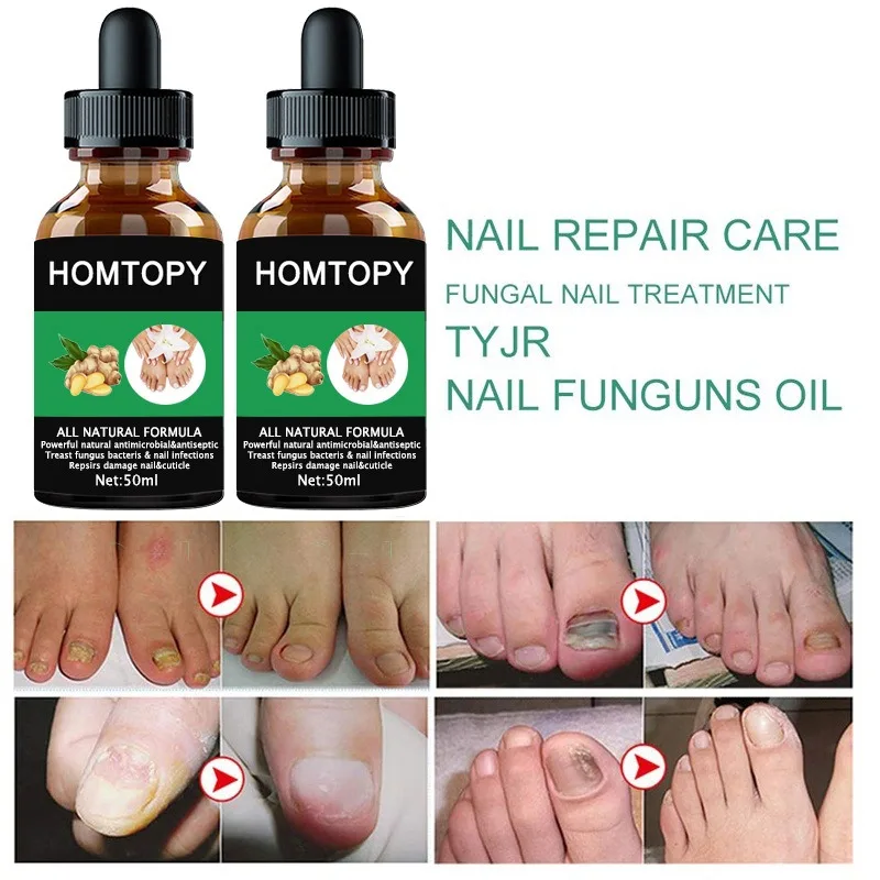 7 Days Nail Fungus Remover Serum Oil Foot Toe Nail Fungus Removal Repair Onychomycosi Anti Infection U&ntilde;as Care Products
