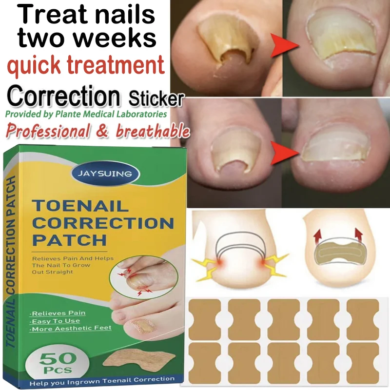 50pcs Nail Correction Stickers Ingrown Toenail Corrector Patches Paronychia Treatment Recover Relieve Nail Involution Foot Care