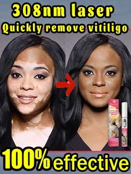 Effective treatment for vitiligo