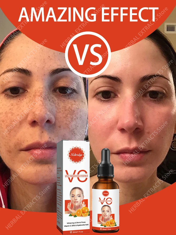 Serum Freckles Chloasma Dark spots Age spots Antiageing serum