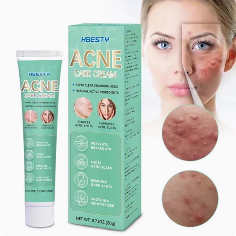 2-10 boxes new product acne care cream repair scars brighten the skin resist external infections directly sold acne care cream 5