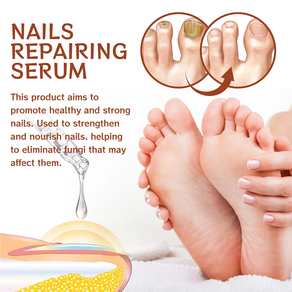 Nail Fungus Treatment Serum Toe Fungal Repair Products Hand Foot Care Removal Gel Anti Infection Onychomycosis Paronychia nail fungus remover