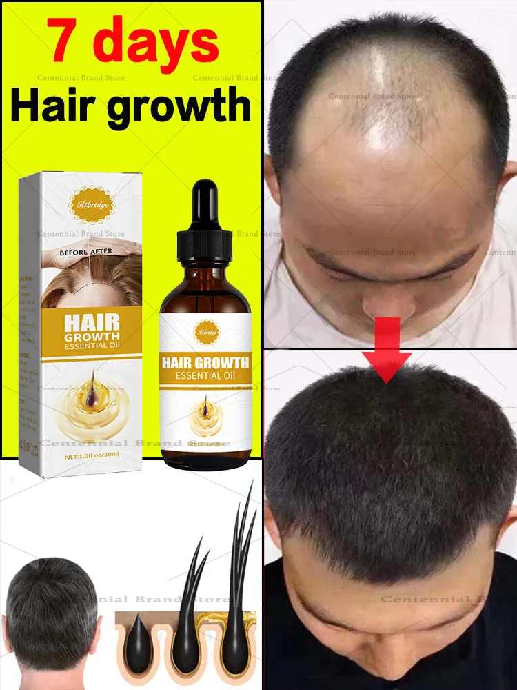 7 Days Rapid Hair Regrowth Essential Oil, Ginger Scalp Treatment, Fix Hair Regrowth