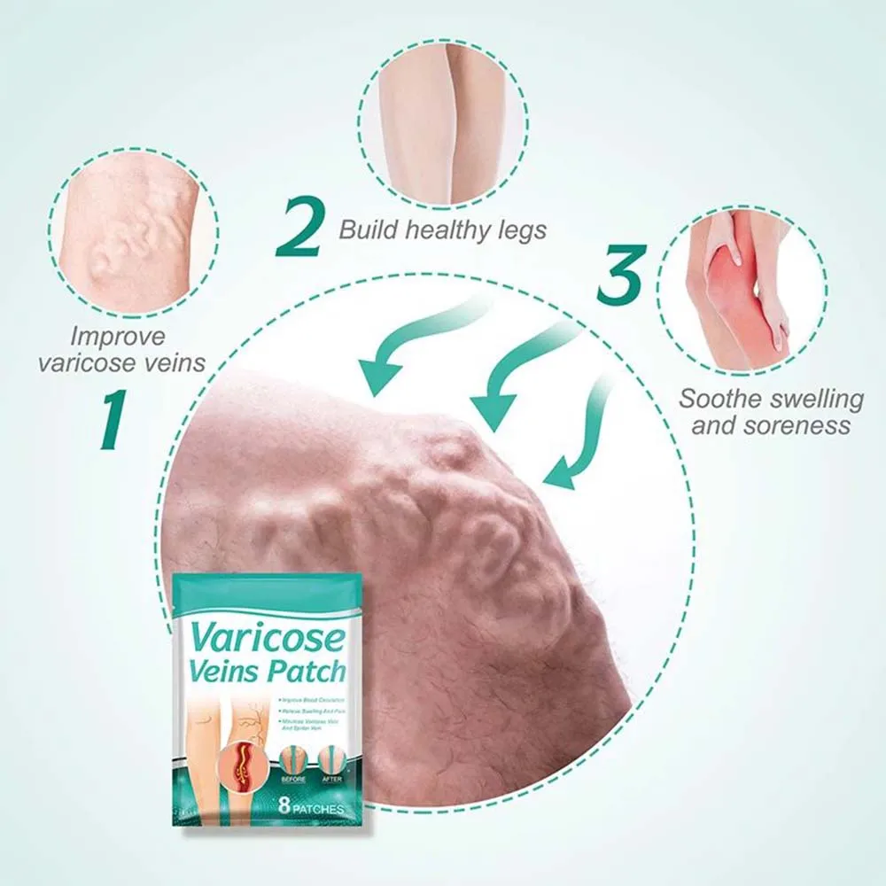 Z20 10PCS Varicose Veins Patch Treatment For Varicose Veins Vasculitis Phlebitis Spider Leg Medical Patch Angiitis Removal