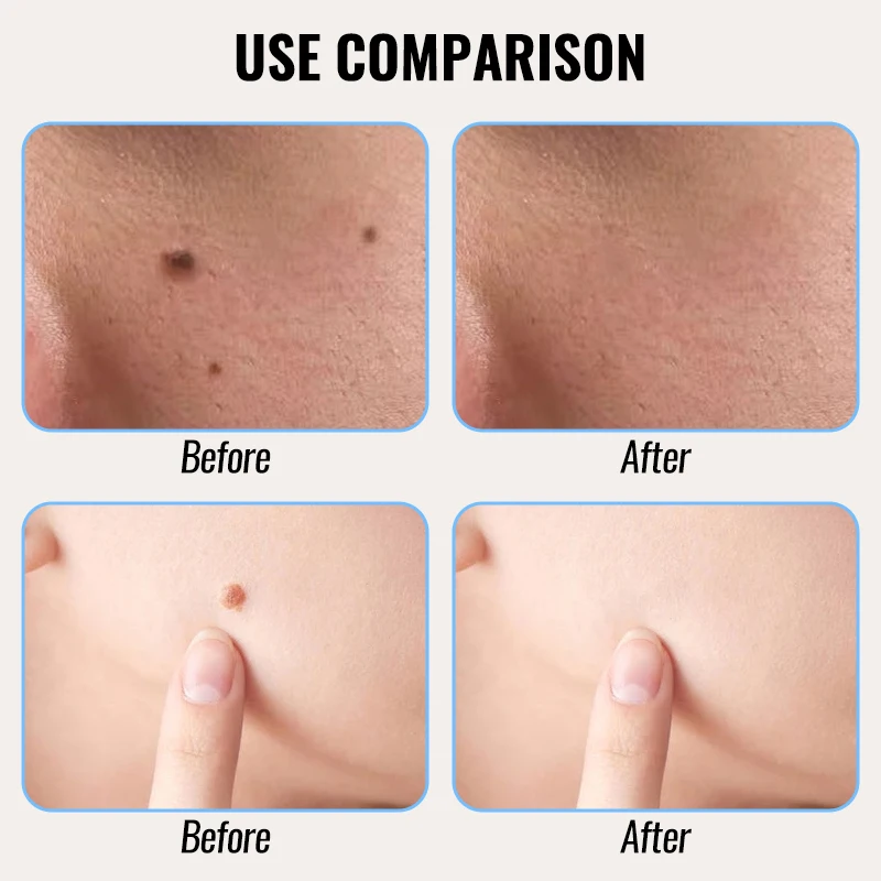 Mini Laser Plasma Pen Portable Freckle Removal Machine Skin Face Wart Tag Remover Tool Household Black Dots Tattoo Remover Salon
