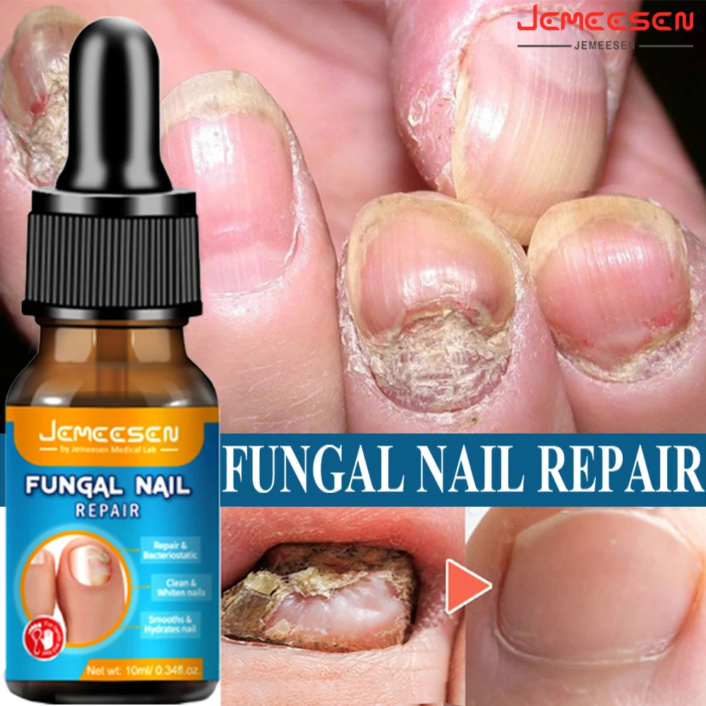 

JEMEESEN Nail Fungal Treatment Feet Care Essence Repair Nail Fungus Removal Serum Gel Anti Infection Paronychia Onychomycosis