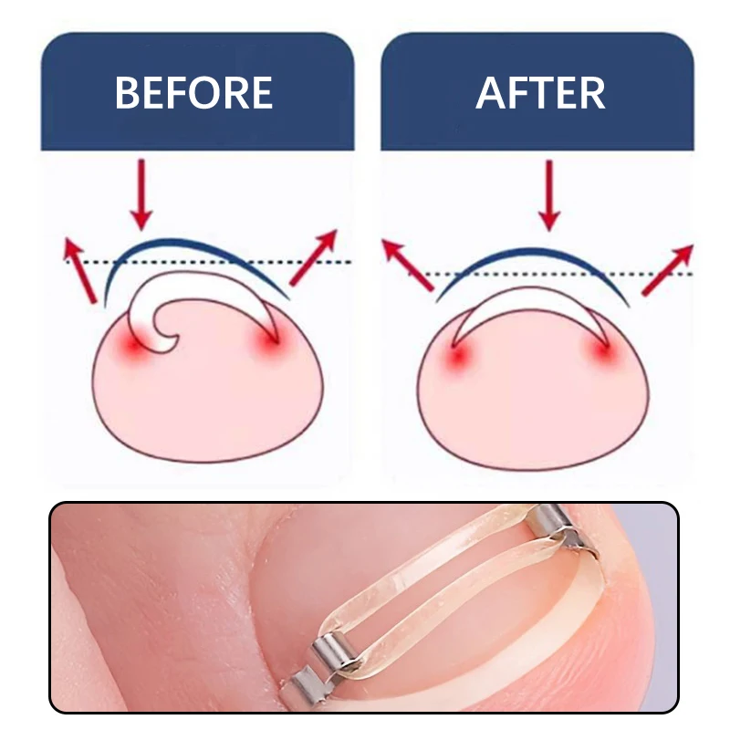 alt="The Professional Kit Ingrown Toenail Corrector Tools, designed for Toe Nail Treatment and Foot Care.