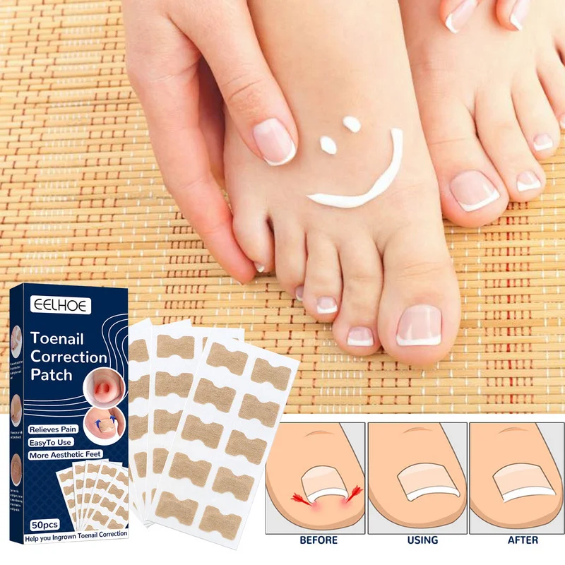 50 Pieces Ingrown Toenail Corrector Strips Toe Nail Correction Pad Nail Correction Stickers