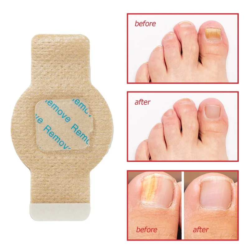 21/32Pcs Toenail Fungus Patch Nail Repair Patches Nail Ingrown Correction Sticker Discolored Damaged Nails Foot Care Tool