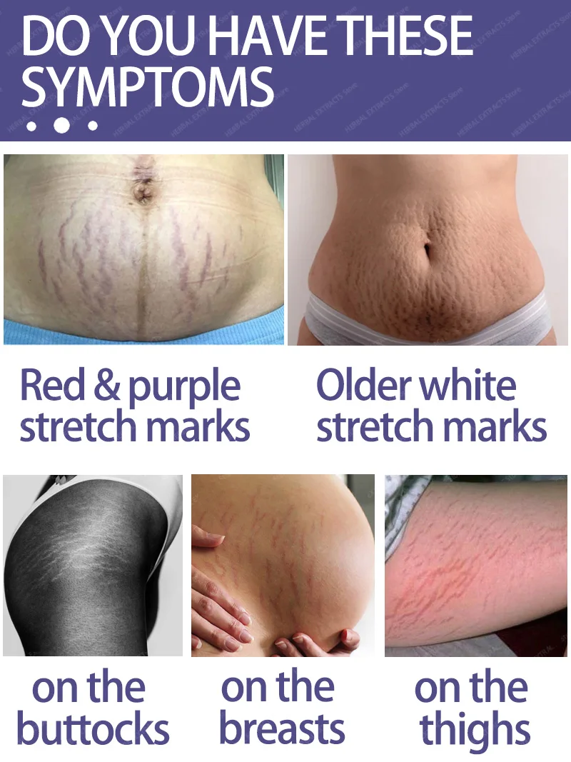 Рисунок 3 - Крем для перманентного Удаления растяжек