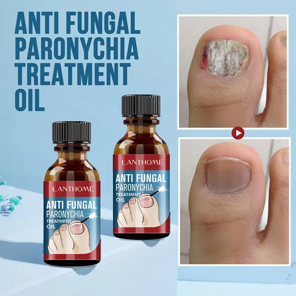 

10ml super strong nail fungus treatment essence care prevent fungus growth repair repair damage nail anti infection putty W1N6