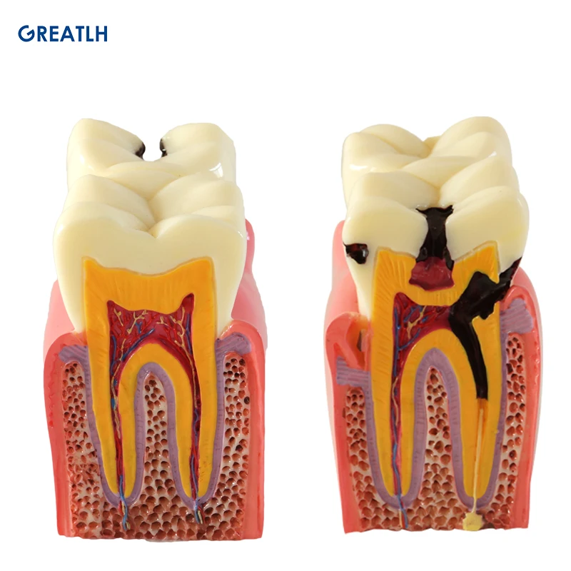 

Dental Anatomy of Dental Caries Plastic Teeth Model Demonstration Communication Teeth Model