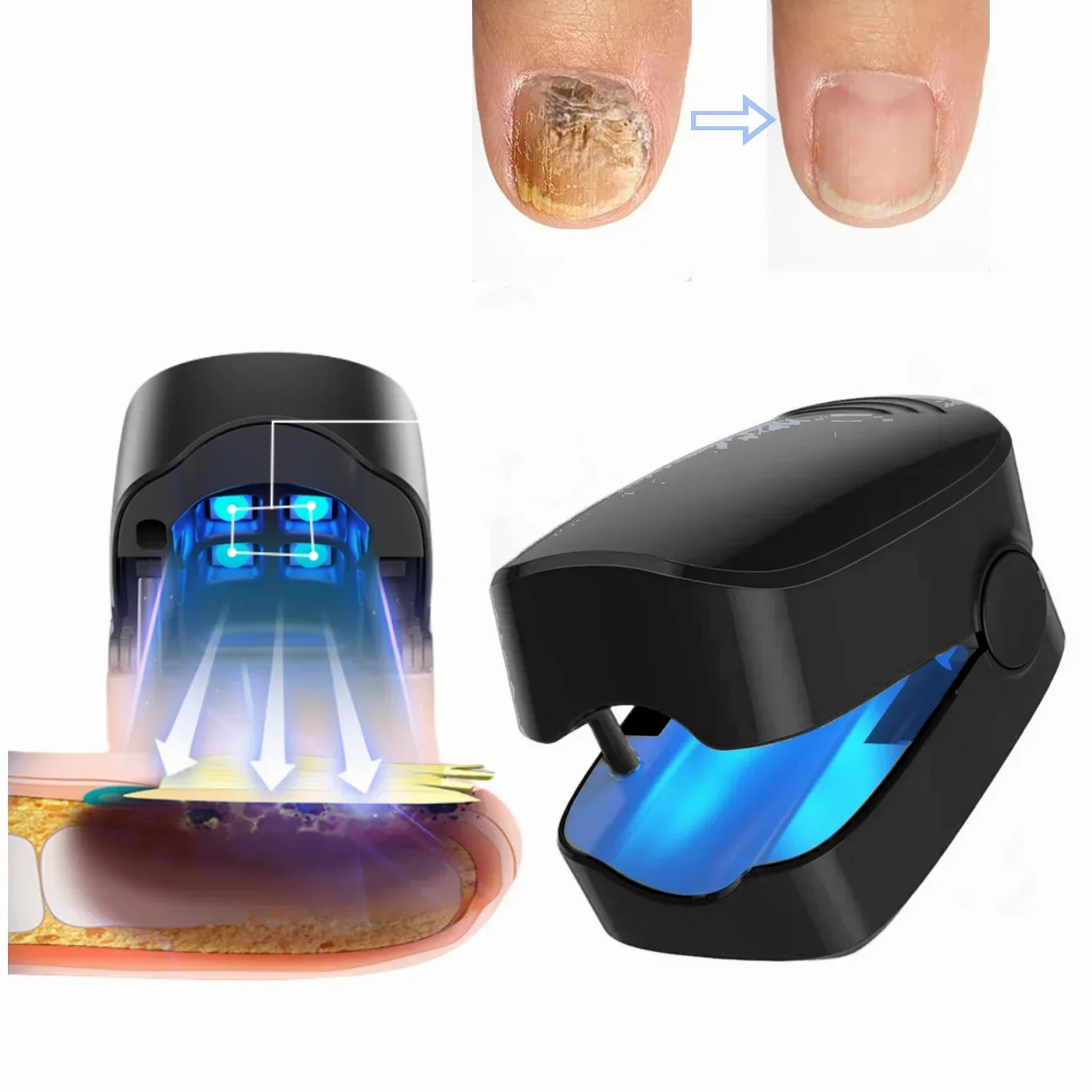 Nail Fungus Treatment Blue Light Nail Salon LED Laser Device for Cleaning Onychomycosis USB Charge 905nm Infrared Light 470nm