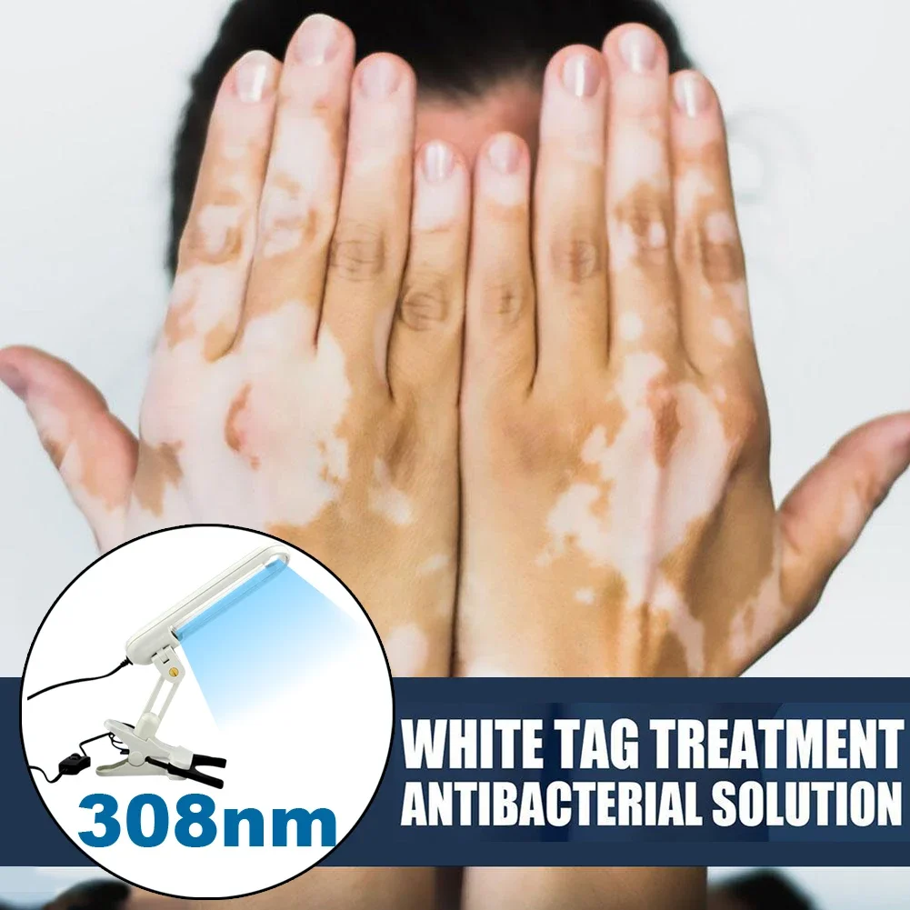 311nm Ultraviolet Phototherapy Instrument Therapy For Vitiligo UVB Light treament Vitiligo Psoriasis White Spots Skin Disease 5