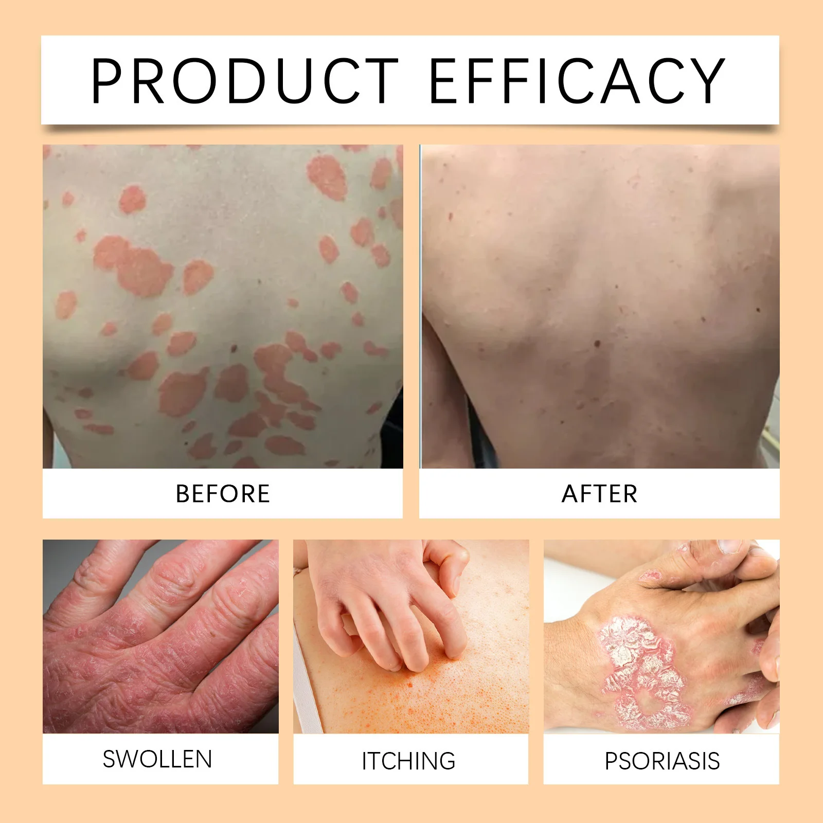 Bee Vonom Psoriasis Treatment Cream Eczema Urticaria Skin Itching Swelling Antibacterial Relieve Rash Desquamation Ointment Care