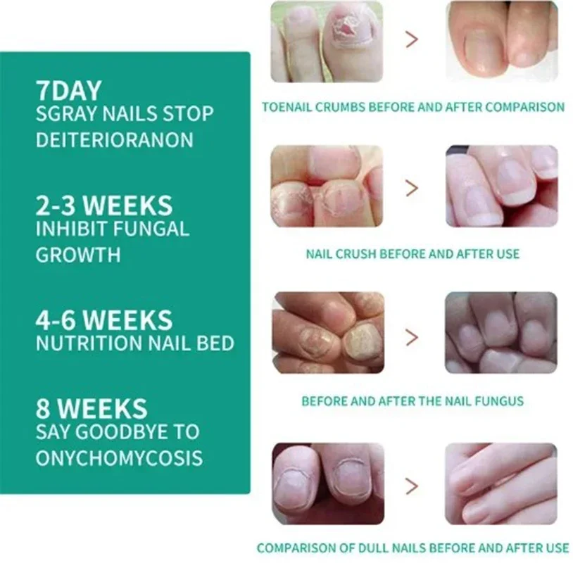 5Nail Fungals Renewal Nail Repair Liquid for Discolored Thickened Crumbled Nails Nail Fungals for Discolored Broken Cracked XXS5