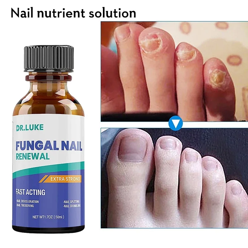 HOT Nail Fungus Treatment Stop Fungal Growth Effective Fingernail