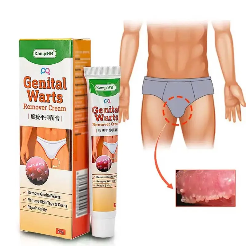 

Мазь KanyeHB от бородавок и бородавок, средство для удаления бородавок с жетонов на коже, удаление бородавок