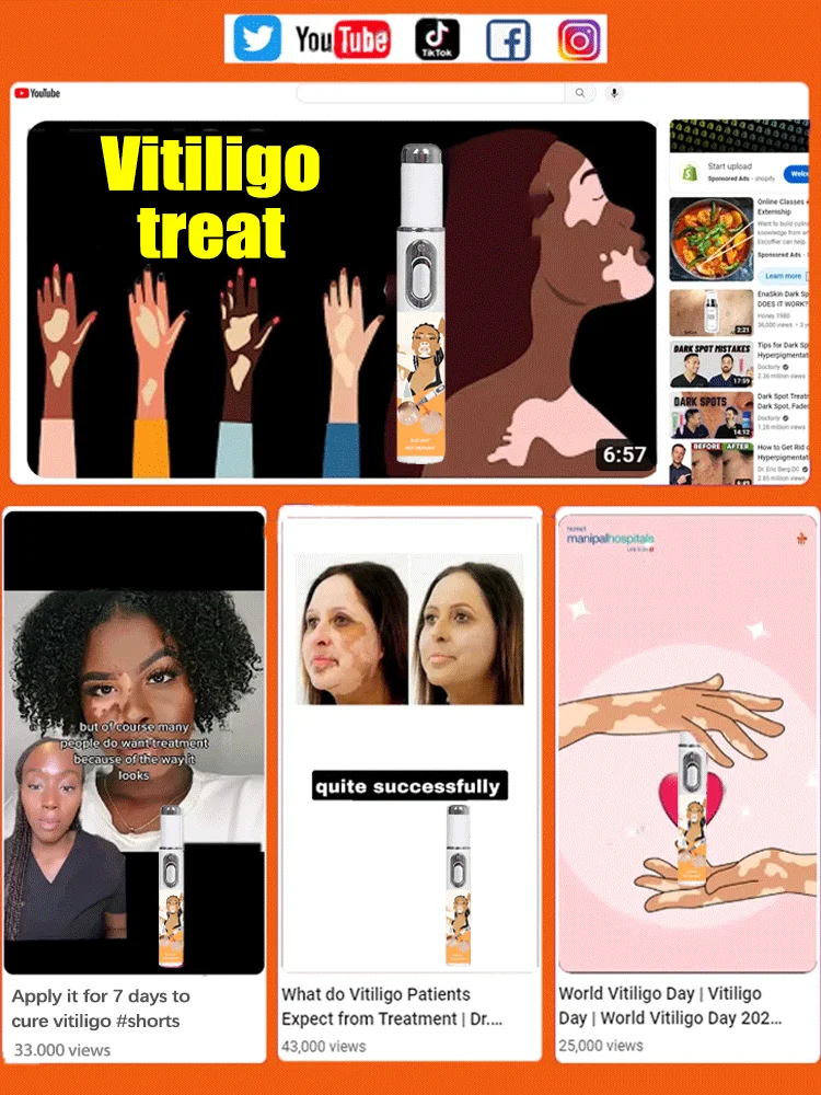 2세대 업그레이드된 백반증 치료제 ? 백반증 치료 ? 빠르게